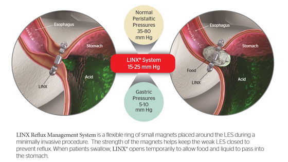Image showing how Linx alows food to pass into the stomach without allowing stomach acid to go up the esophagus
